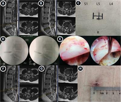 A comparative study of single and double incision for L4/5 and L5/S1 double-level percutaneous interlaminar lumbar discectomy